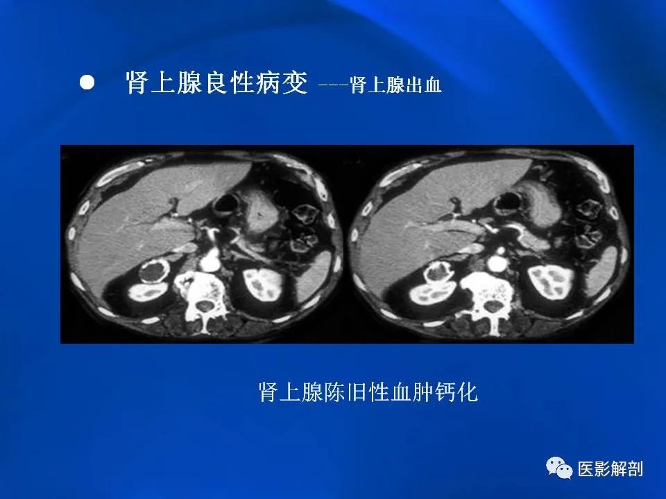 影像PPT - 【PPT】肾上腺解剖及相关病变的影像诊断-56