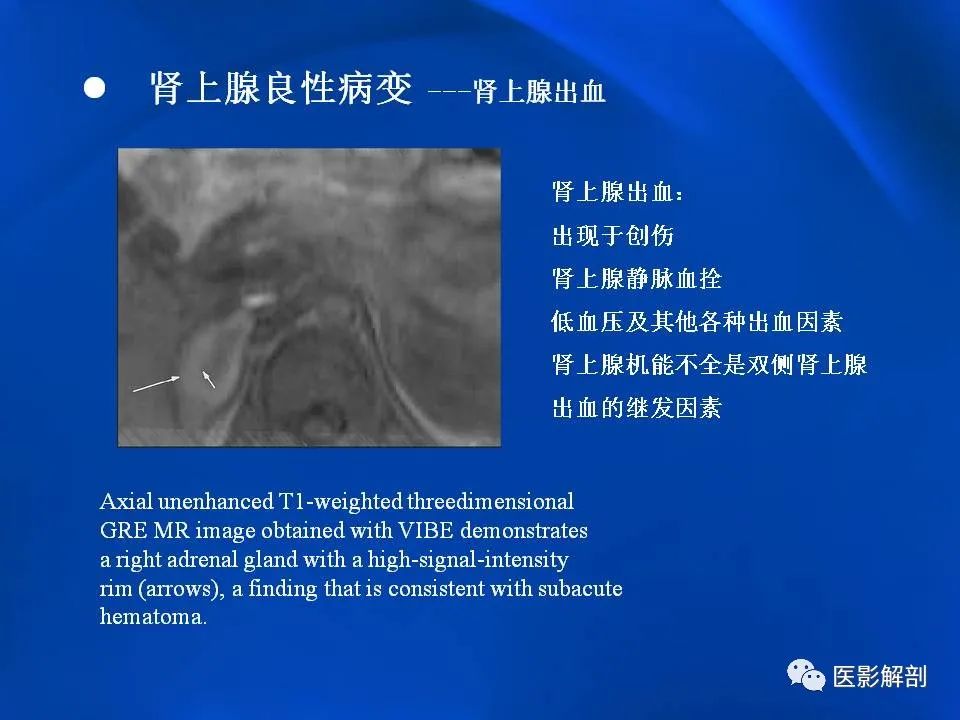 影像PPT - 【PPT】肾上腺解剖及相关病变的影像诊断-57