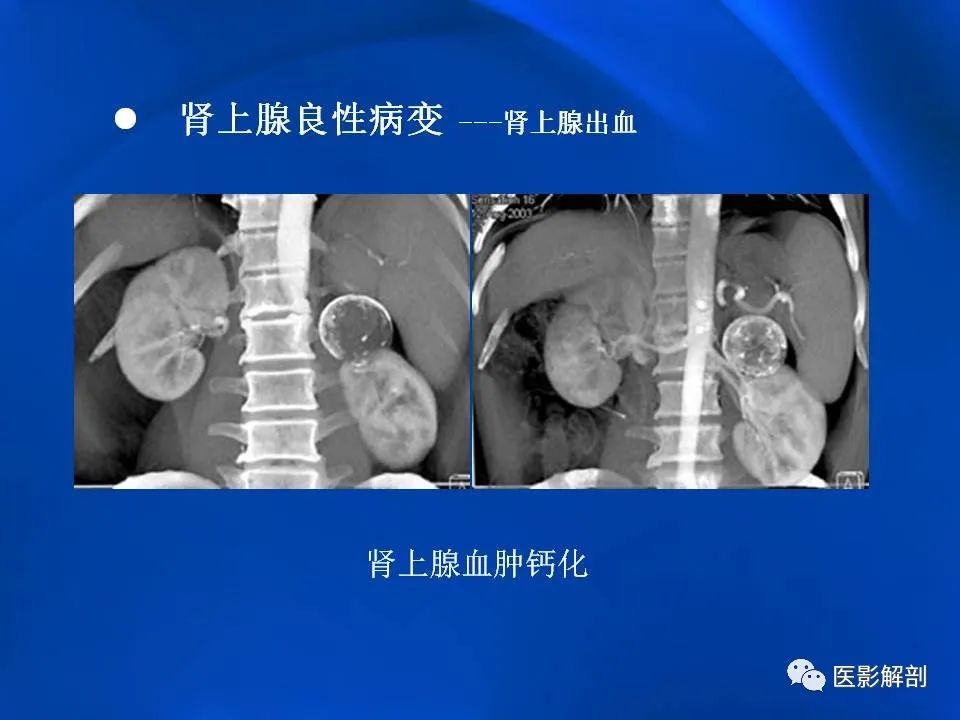 影像PPT - 【PPT】肾上腺解剖及相关病变的影像诊断-58