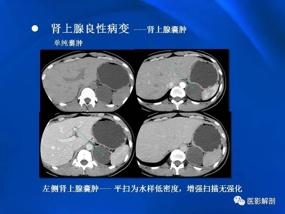 影像PPT - 【PPT】肾上腺解剖及相关病变的影像诊断-62