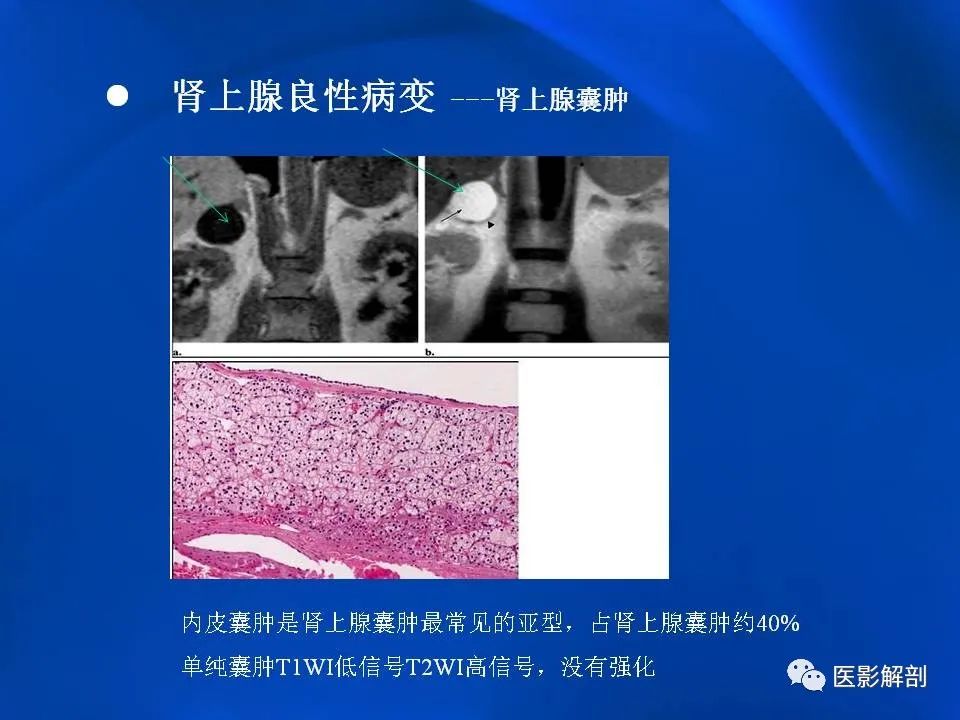 影像PPT - 【PPT】肾上腺解剖及相关病变的影像诊断-63