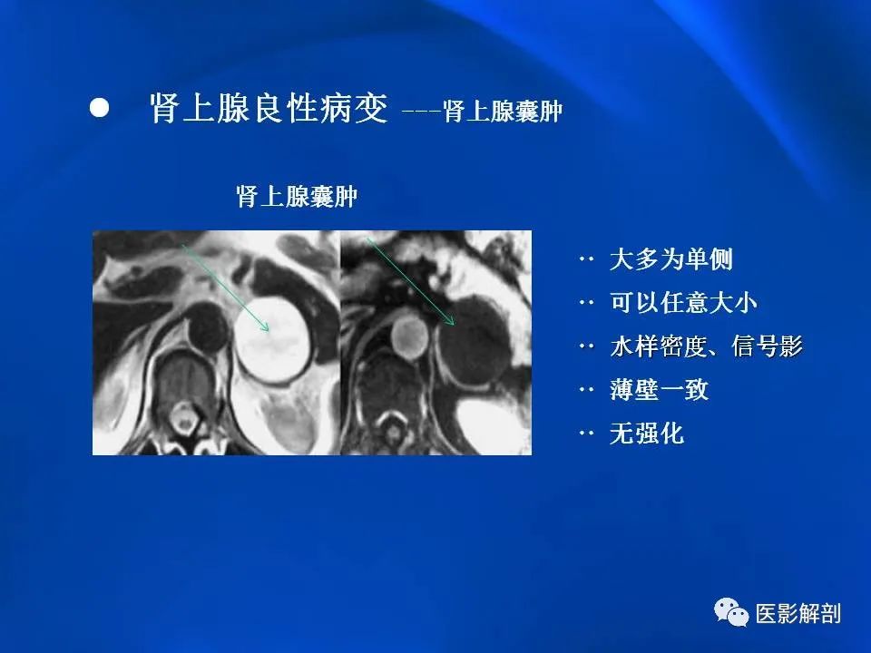 影像PPT - 【PPT】肾上腺解剖及相关病变的影像诊断-65