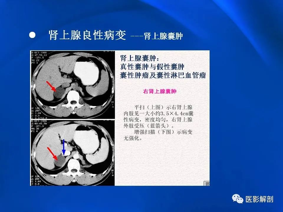 影像PPT - 【PPT】肾上腺解剖及相关病变的影像诊断-66