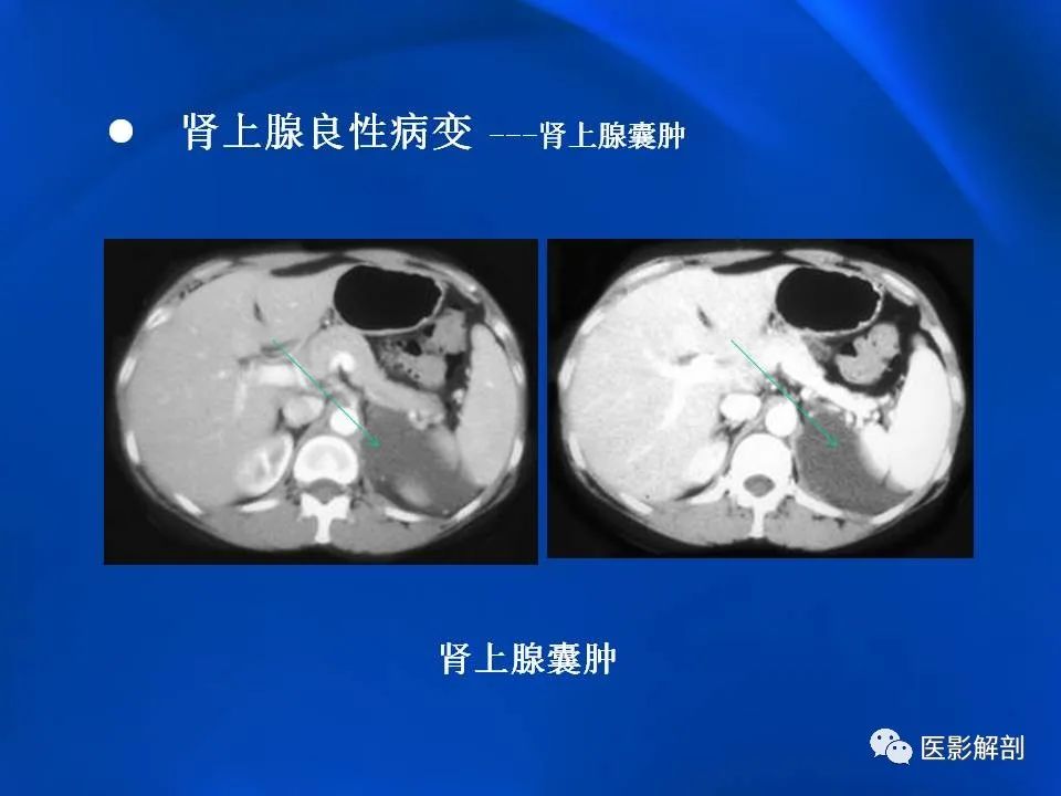 影像PPT - 【PPT】肾上腺解剖及相关病变的影像诊断-64