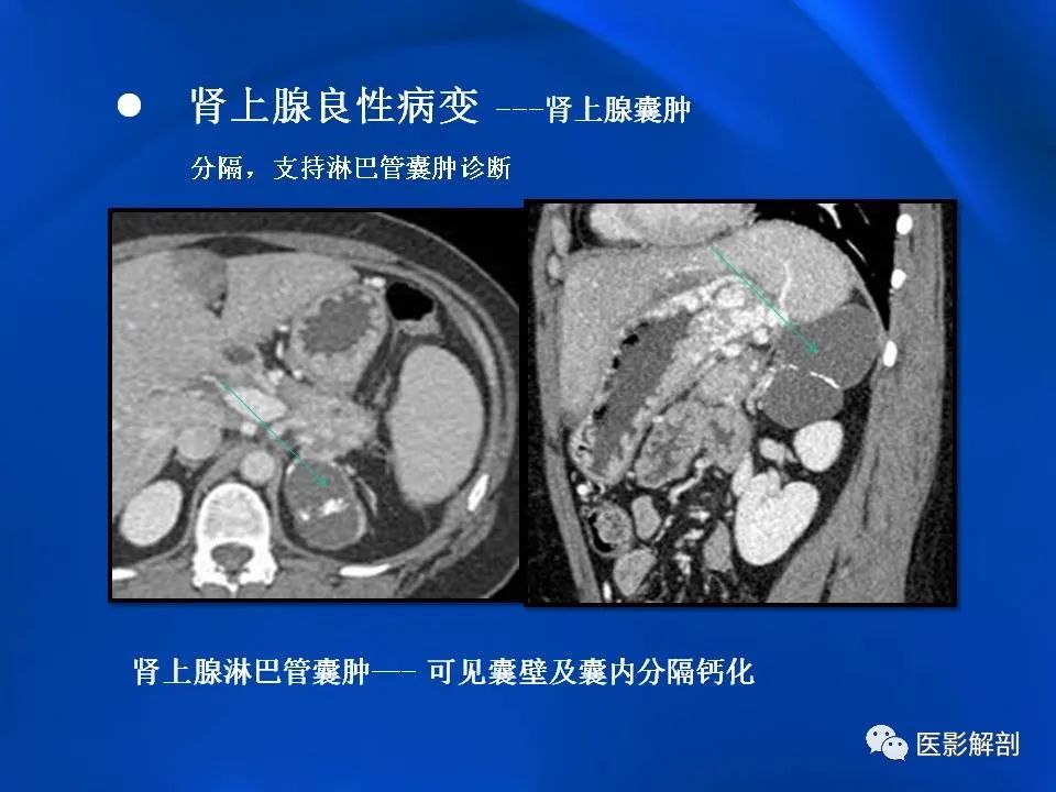 影像PPT - 【PPT】肾上腺解剖及相关病变的影像诊断-67