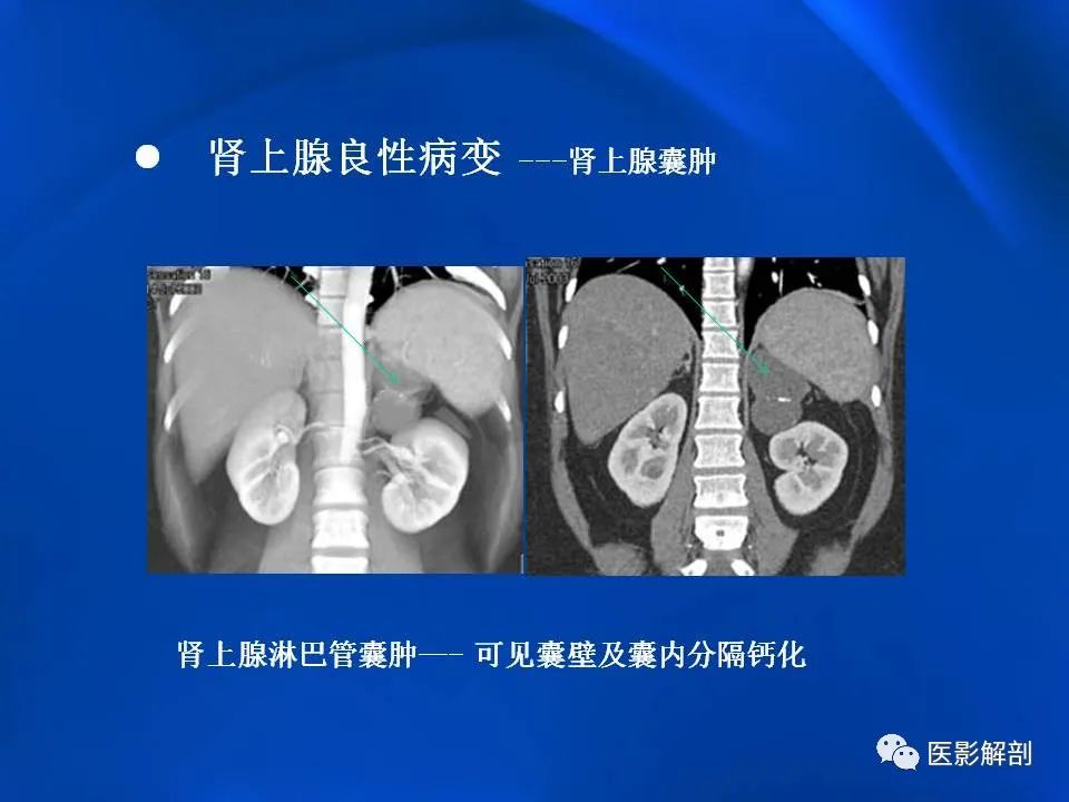 影像PPT - 【PPT】肾上腺解剖及相关病变的影像诊断-68