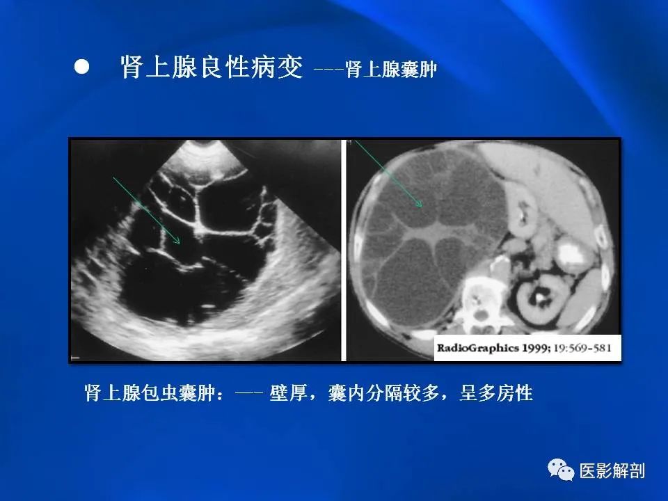 影像PPT - 【PPT】肾上腺解剖及相关病变的影像诊断-69