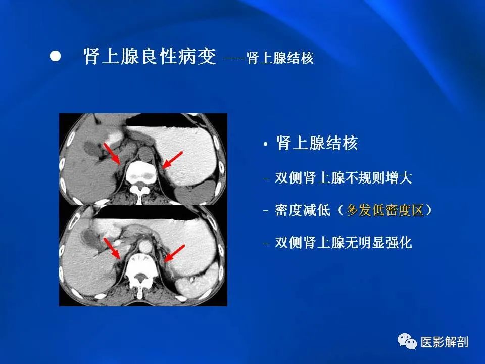 影像PPT - 【PPT】肾上腺解剖及相关病变的影像诊断-71