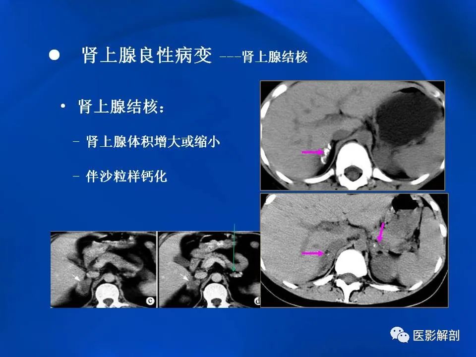 影像PPT - 【PPT】肾上腺解剖及相关病变的影像诊断-72