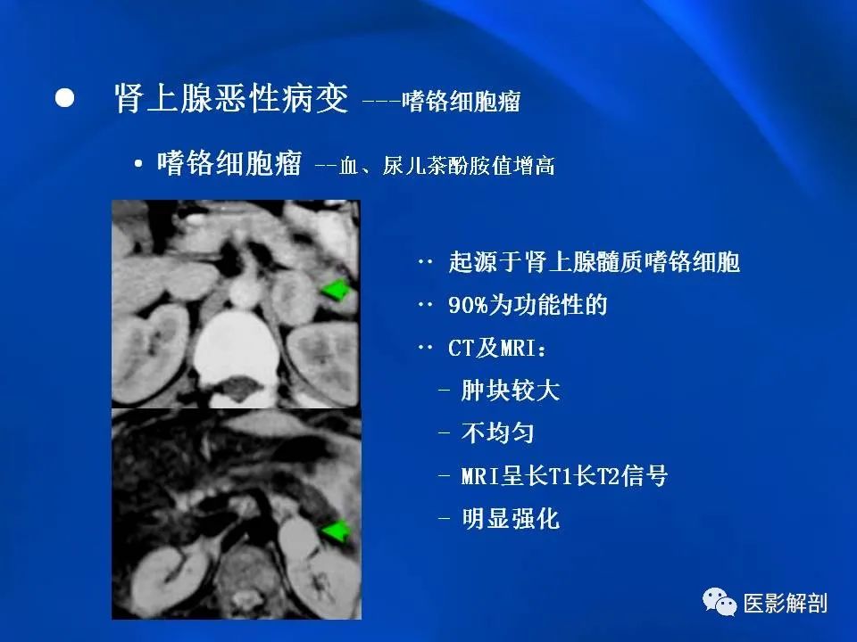 影像PPT - 【PPT】肾上腺解剖及相关病变的影像诊断-73