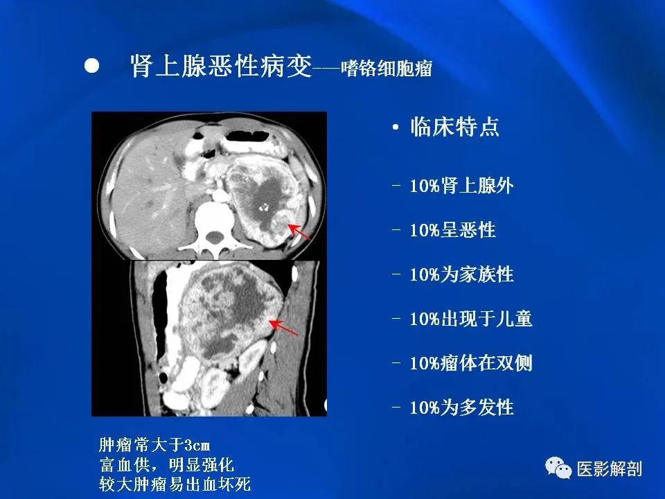 影像PPT - 【PPT】肾上腺解剖及相关病变的影像诊断-74