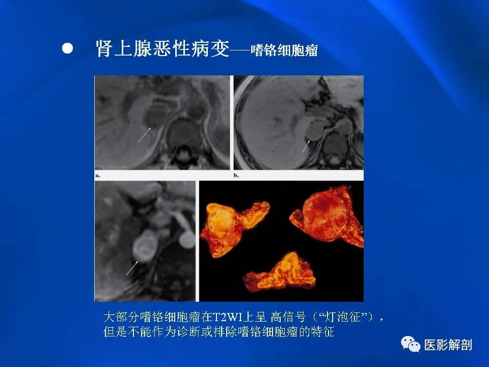 影像PPT - 【PPT】肾上腺解剖及相关病变的影像诊断-75