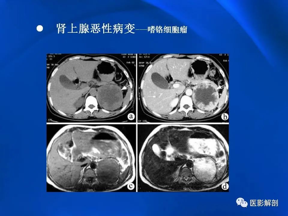 影像PPT - 【PPT】肾上腺解剖及相关病变的影像诊断-76