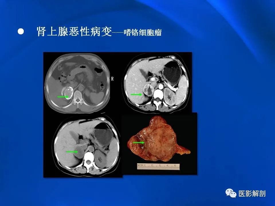 影像PPT - 【PPT】肾上腺解剖及相关病变的影像诊断-78