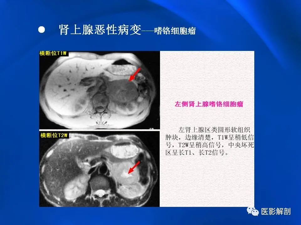 影像PPT - 【PPT】肾上腺解剖及相关病变的影像诊断-77