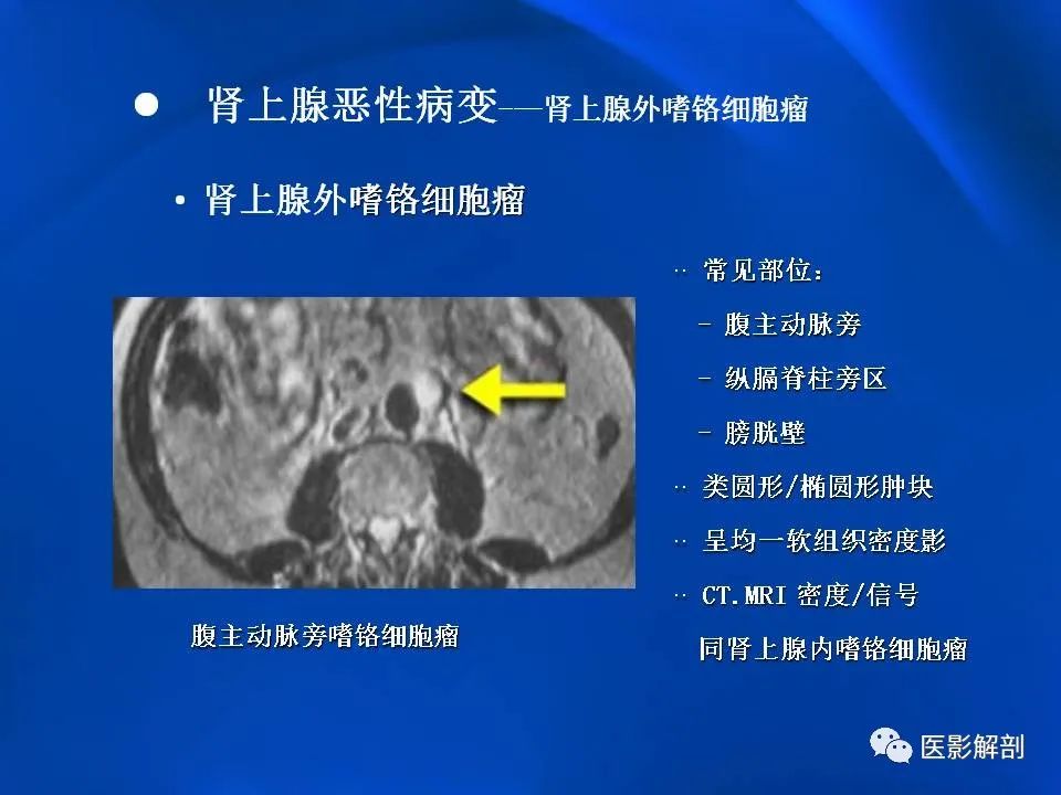 影像PPT - 【PPT】肾上腺解剖及相关病变的影像诊断-79