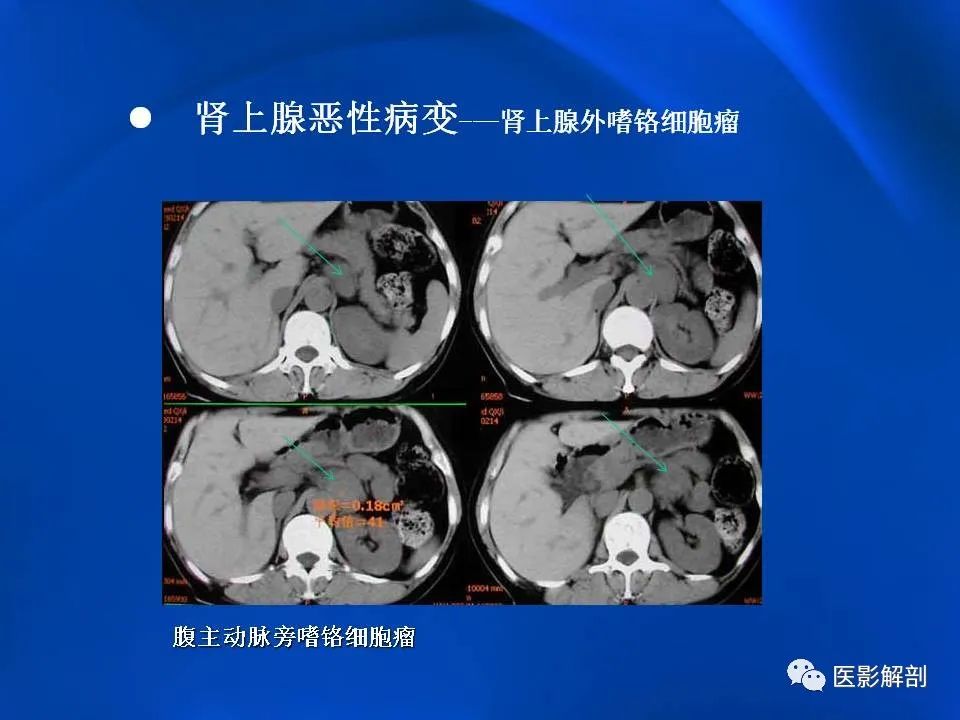 影像PPT - 【PPT】肾上腺解剖及相关病变的影像诊断-80