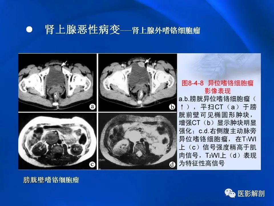 影像PPT - 【PPT】肾上腺解剖及相关病变的影像诊断-81