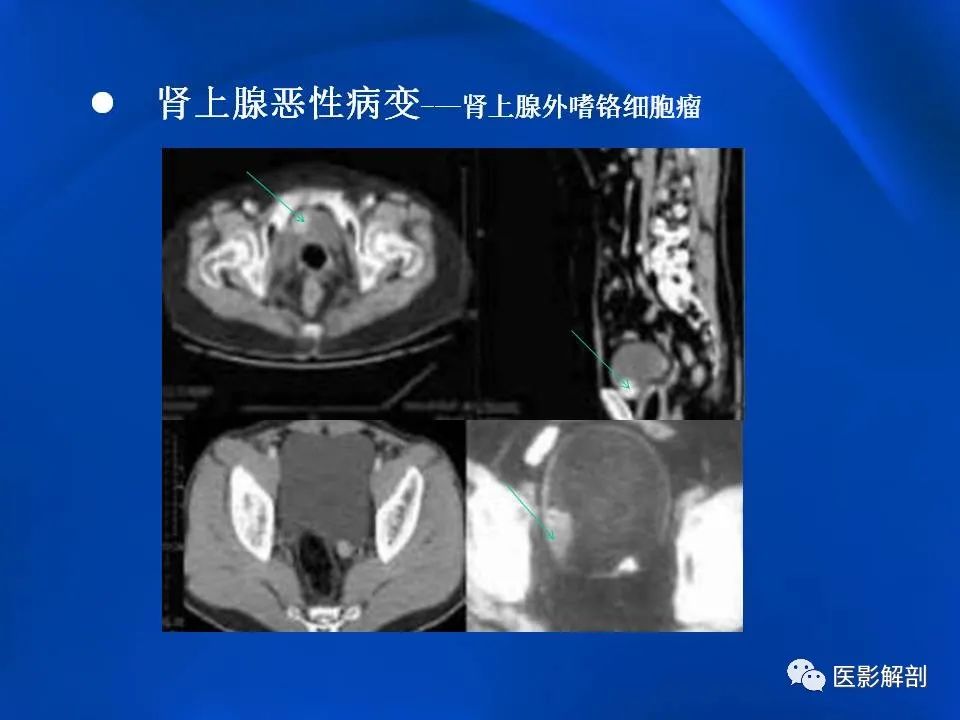 影像PPT - 【PPT】肾上腺解剖及相关病变的影像诊断-82