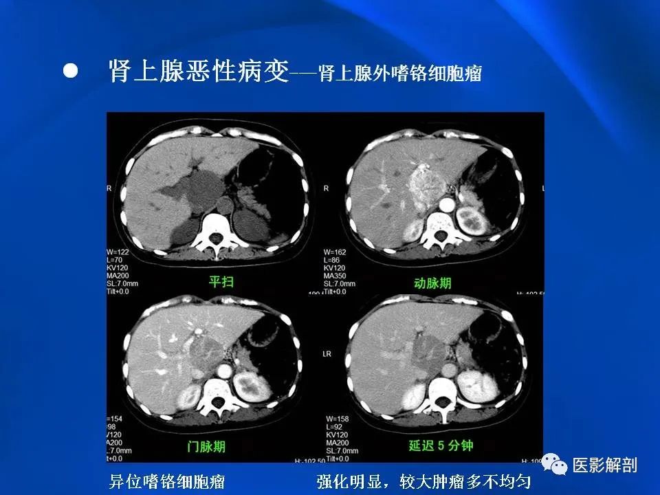 影像PPT - 【PPT】肾上腺解剖及相关病变的影像诊断-83