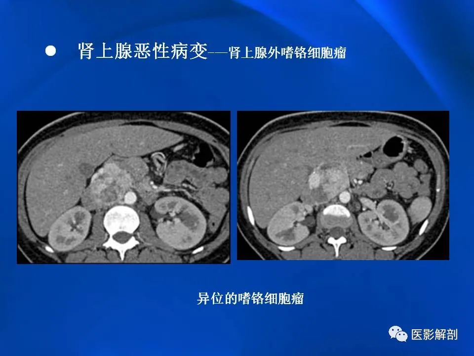 影像PPT - 【PPT】肾上腺解剖及相关病变的影像诊断-84