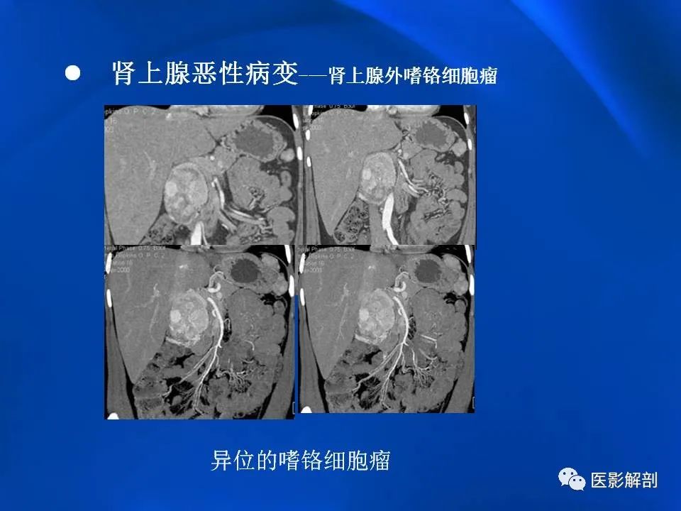 影像PPT - 【PPT】肾上腺解剖及相关病变的影像诊断-85