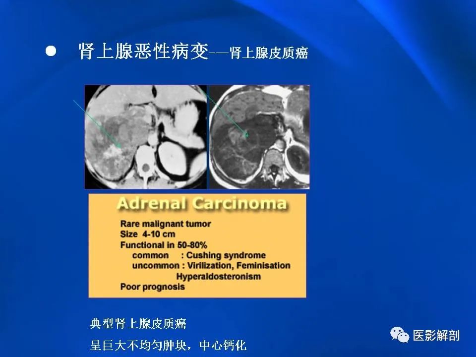 影像PPT - 【PPT】肾上腺解剖及相关病变的影像诊断-87