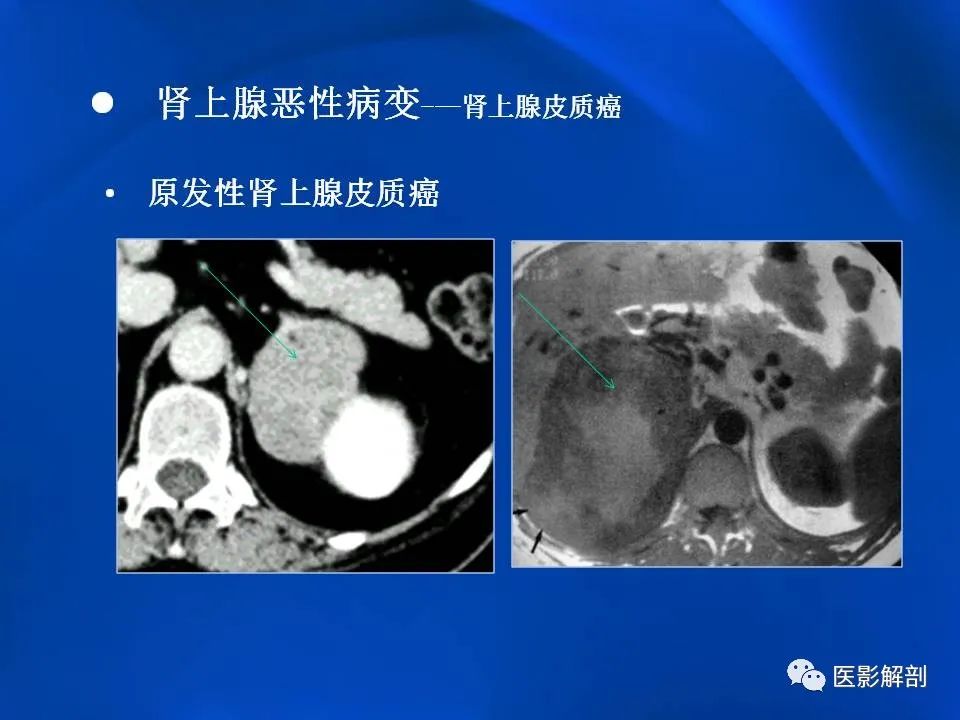 影像PPT - 【PPT】肾上腺解剖及相关病变的影像诊断-88
