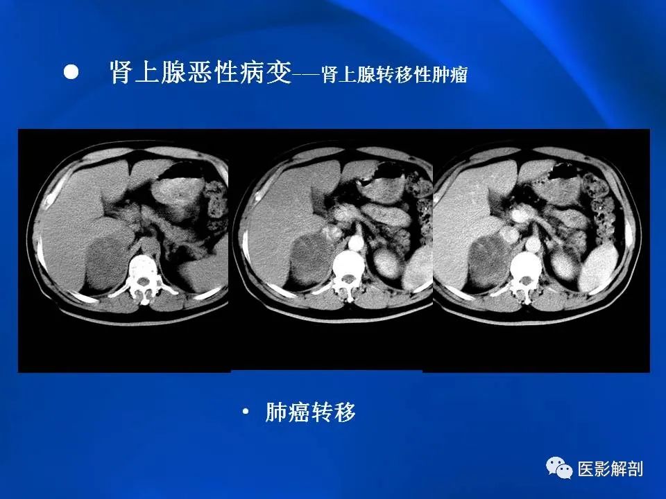 影像PPT - 【PPT】肾上腺解剖及相关病变的影像诊断-90