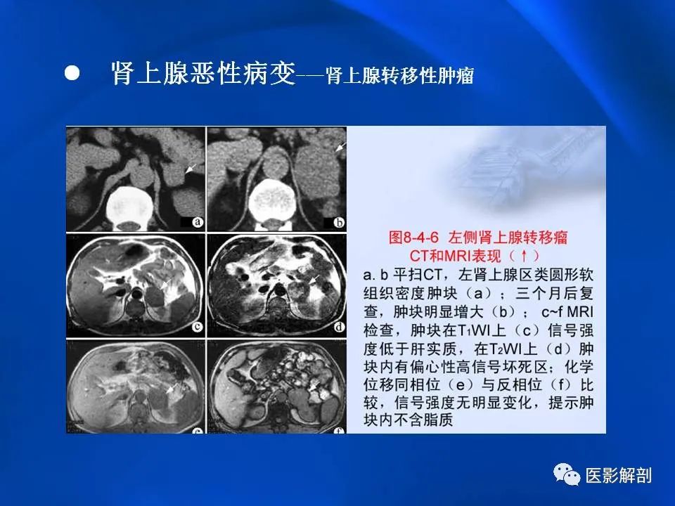 影像PPT - 【PPT】肾上腺解剖及相关病变的影像诊断-91
