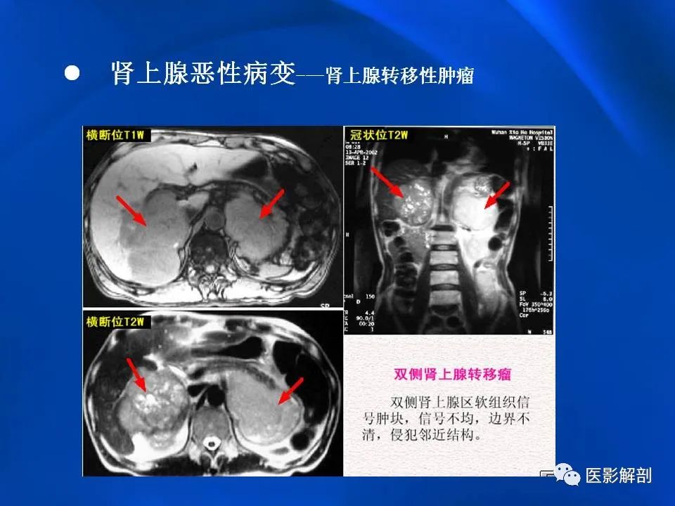 影像PPT - 【PPT】肾上腺解剖及相关病变的影像诊断-92