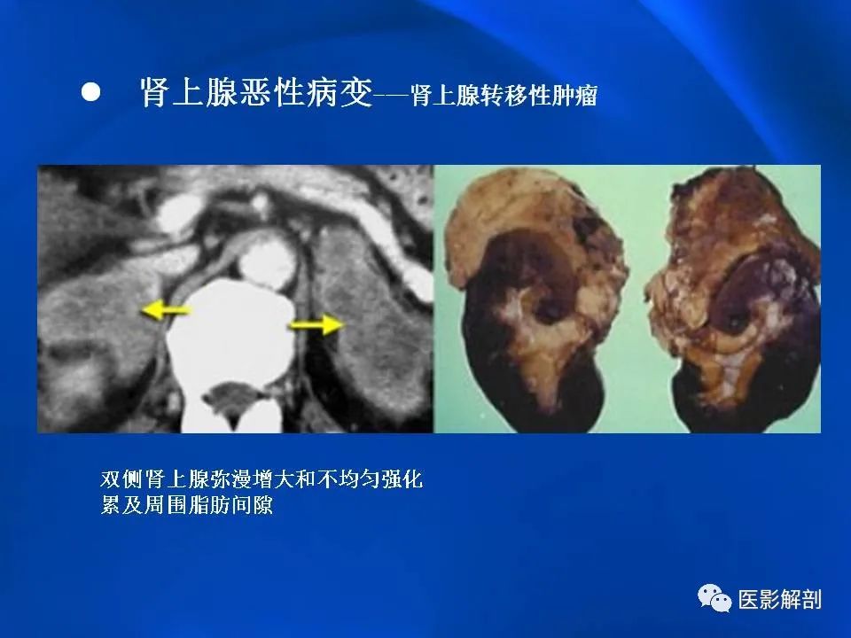影像PPT - 【PPT】肾上腺解剖及相关病变的影像诊断-93