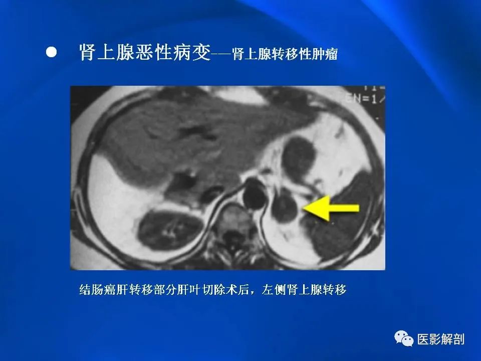 影像PPT - 【PPT】肾上腺解剖及相关病变的影像诊断-94