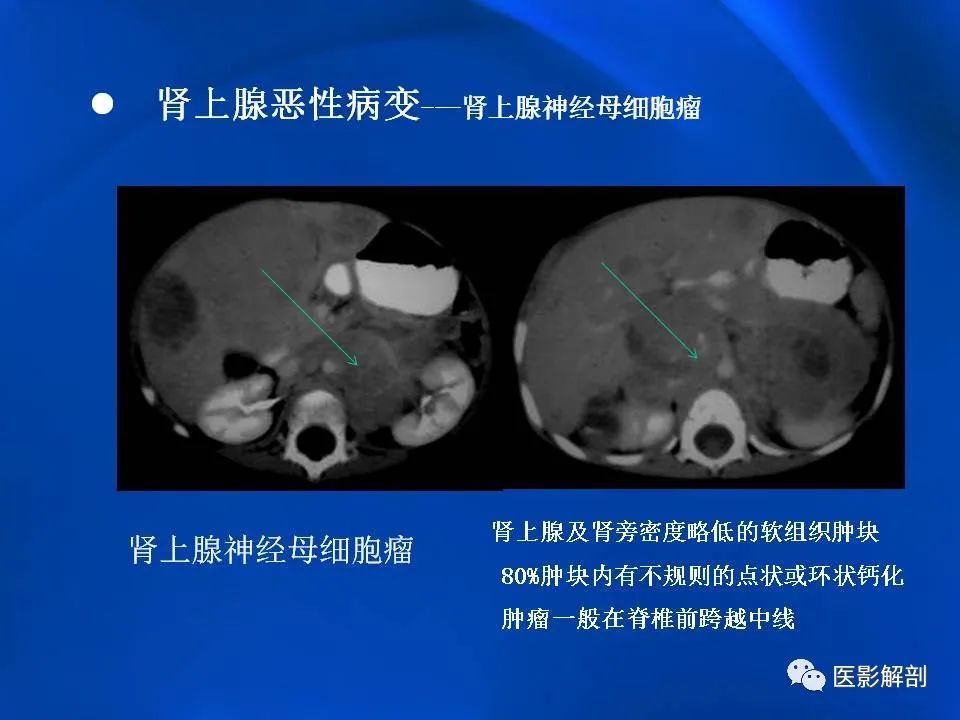 影像PPT - 【PPT】肾上腺解剖及相关病变的影像诊断-96