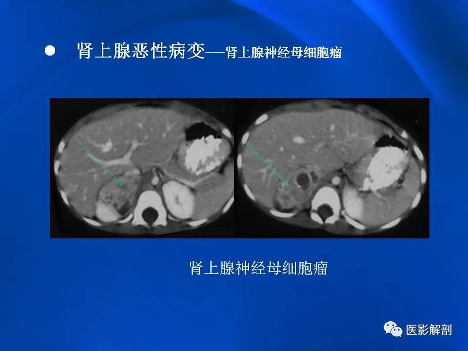 影像PPT - 【PPT】肾上腺解剖及相关病变的影像诊断-97