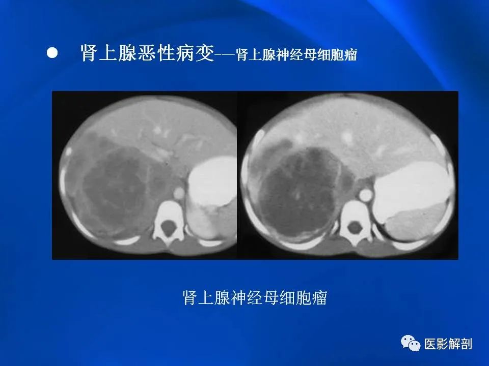 影像PPT - 【PPT】肾上腺解剖及相关病变的影像诊断-98