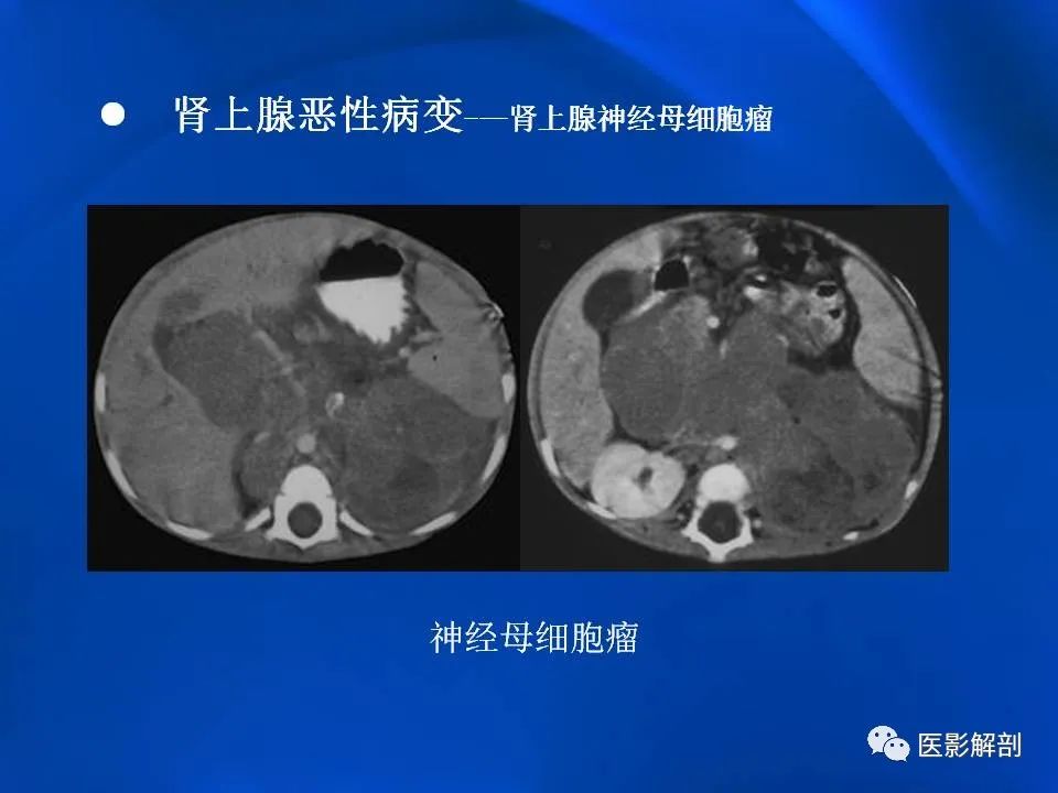 影像PPT - 【PPT】肾上腺解剖及相关病变的影像诊断-99
