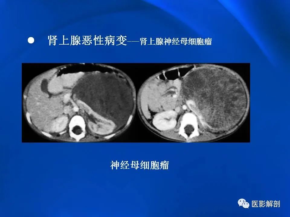 影像PPT - 【PPT】肾上腺解剖及相关病变的影像诊断-100
