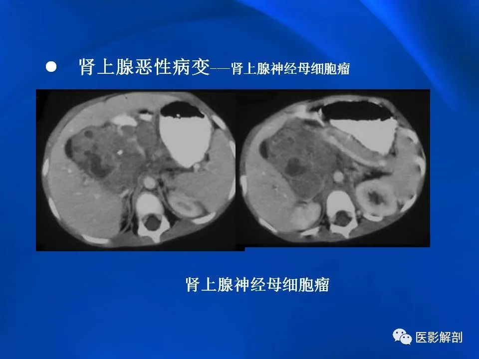 影像PPT - 【PPT】肾上腺解剖及相关病变的影像诊断-101