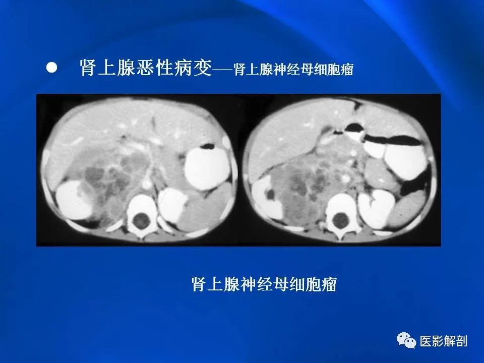 影像PPT - 【PPT】肾上腺解剖及相关病变的影像诊断-102