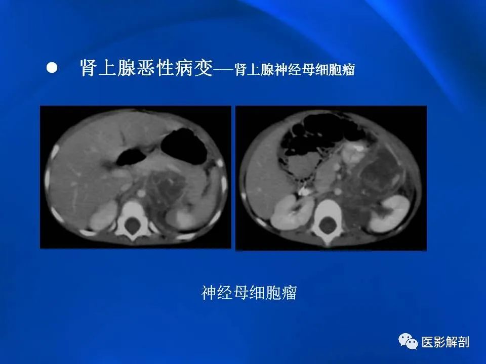 影像PPT - 【PPT】肾上腺解剖及相关病变的影像诊断-103