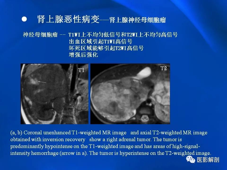 影像PPT - 【PPT】肾上腺解剖及相关病变的影像诊断-104