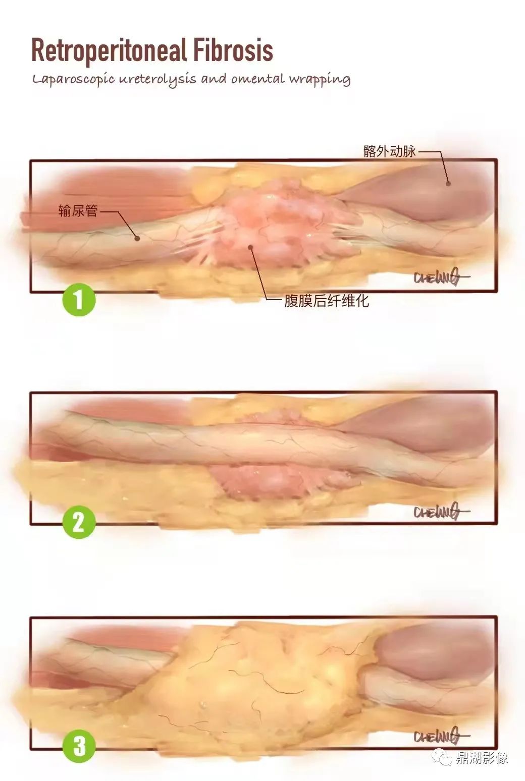 影像PPT - 腹膜后纤维化——少女腰征(Maiden waist deformity)-5 影像PPT - 腹膜后纤维化——少女腰征(Maiden waist deformity)-5