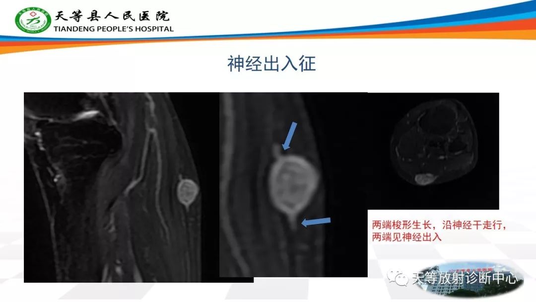 影像PPT - 【PPT】软组织神经鞘瘤影像学诊断-2