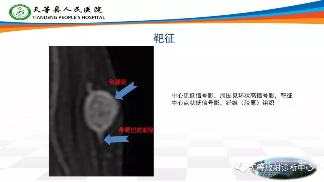 影像PPT - 【PPT】软组织神经鞘瘤影像学诊断-3