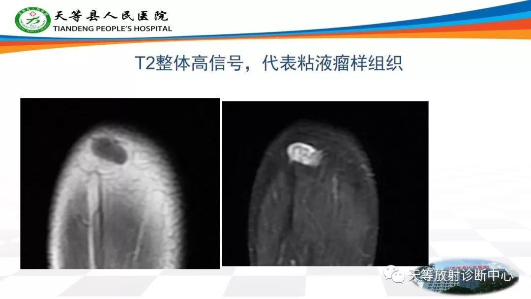 影像PPT - 【PPT】软组织神经鞘瘤影像学诊断-4