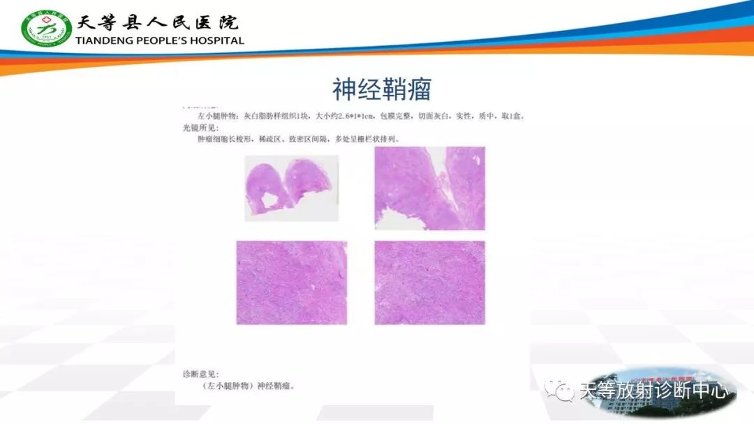 影像PPT - 【PPT】软组织神经鞘瘤影像学诊断-5