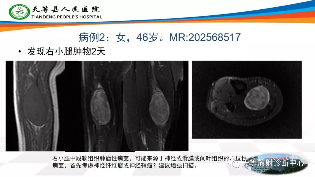 影像PPT - 【PPT】软组织神经鞘瘤影像学诊断-6