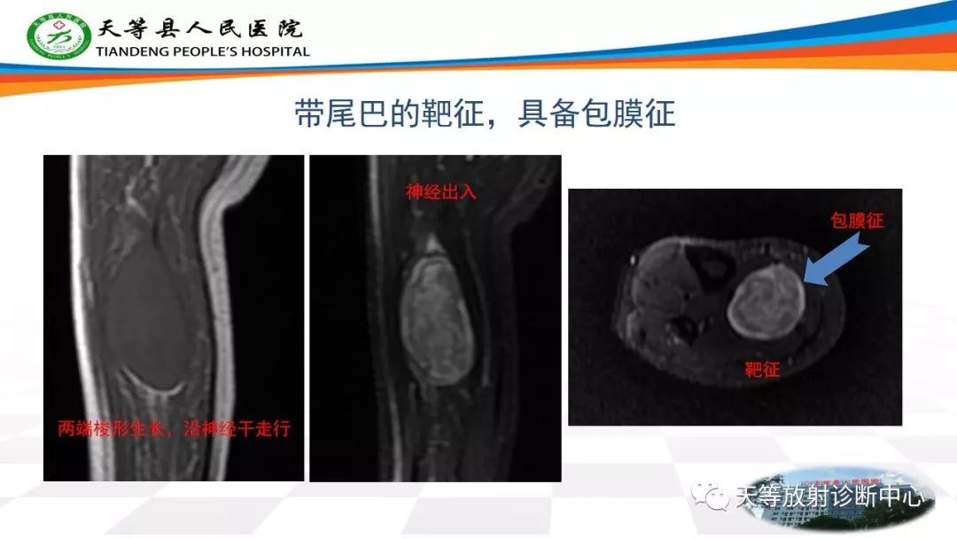 影像PPT - 【PPT】软组织神经鞘瘤影像学诊断-7