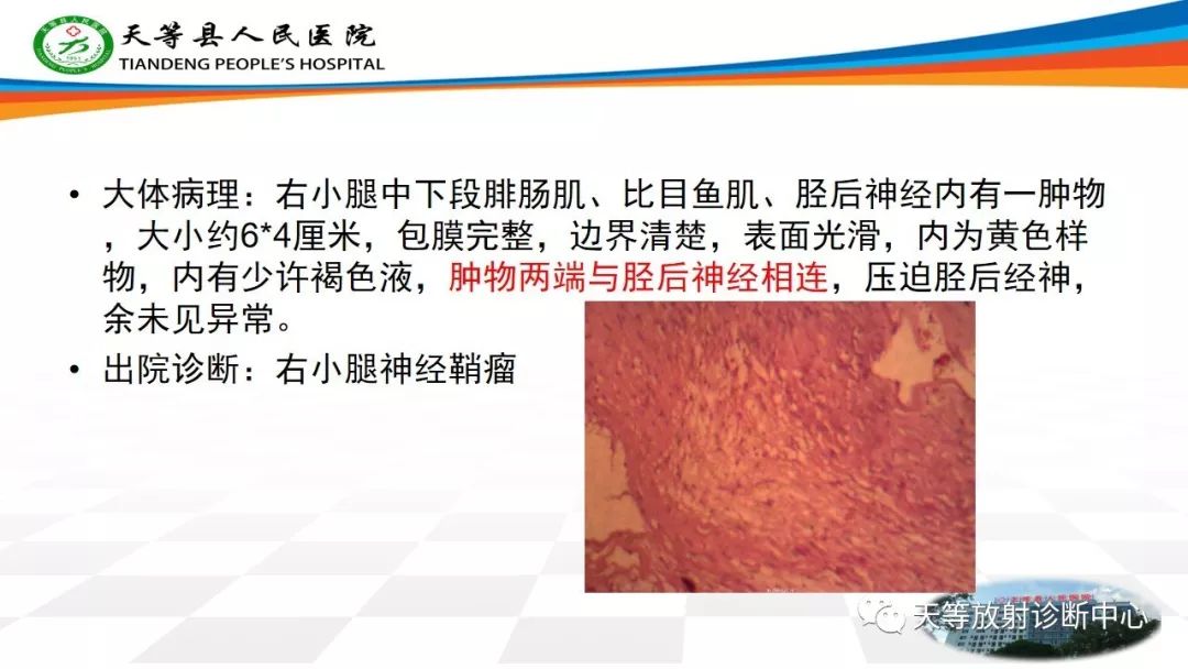 影像PPT - 【PPT】软组织神经鞘瘤影像学诊断-8